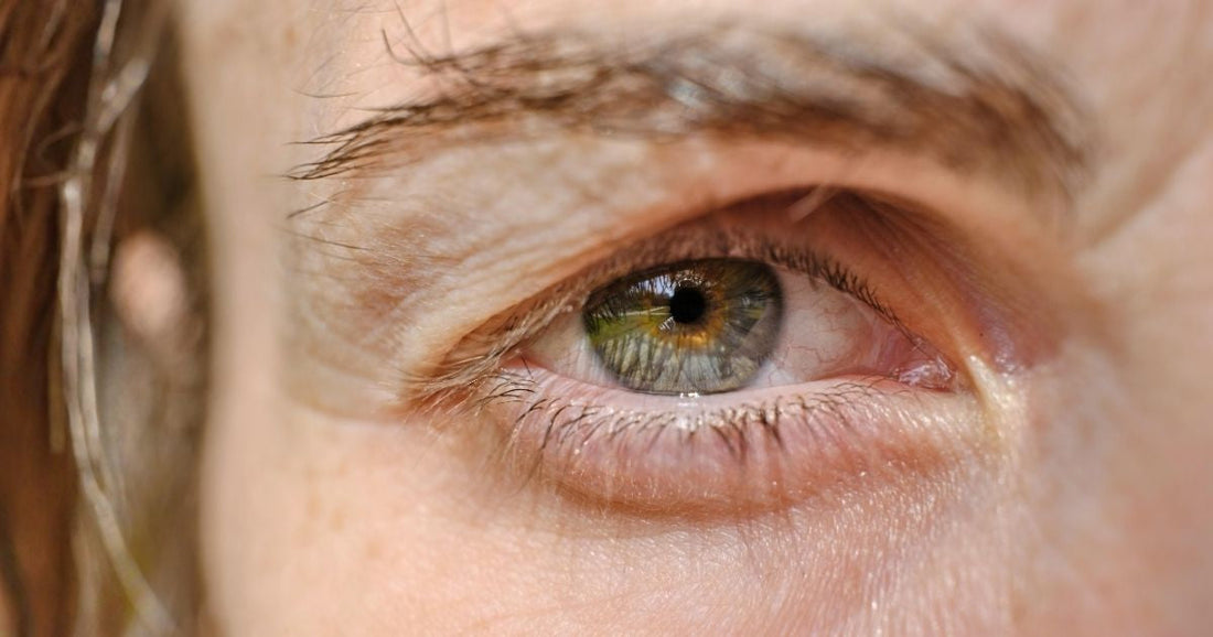 Dark under eye circles