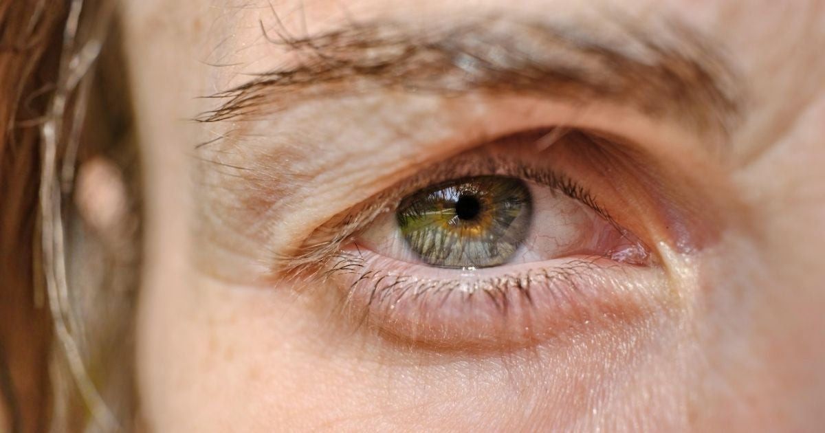 Dark under eye circles